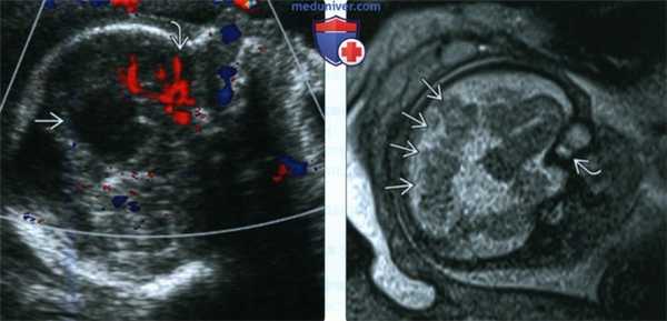 Лучевые признаки колобомы у плода