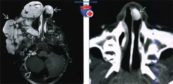 КТ, МРТ при младенческой гемангиоме головы и шеи