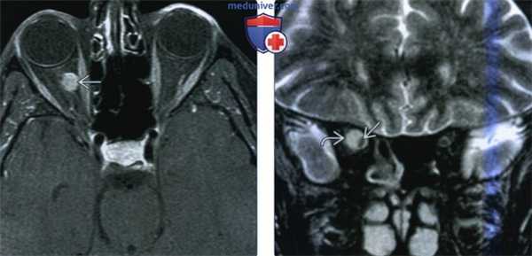 КТ, МРТ при менингиоме оболочек зрительного нерва