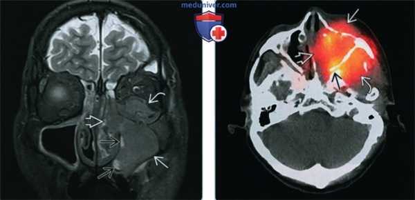 Синоназальный нейроэндокринный рак - лучевая диагностика