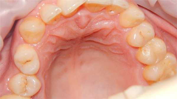 Киста носонёбного (резцового) канала