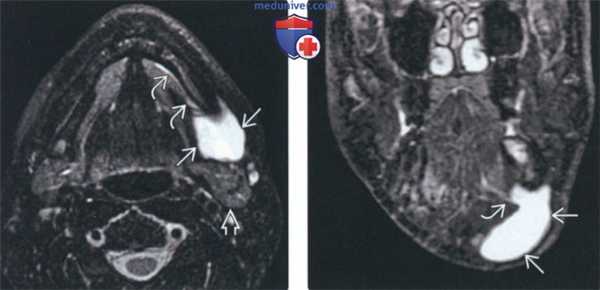 КТ, МРТ при рануле