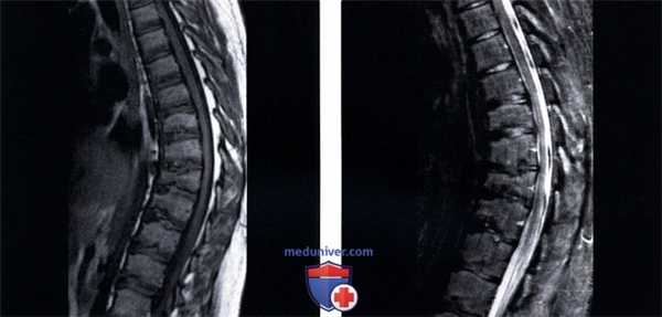 Рентгенограмма, КТ, МРТ болезни Шейерманна