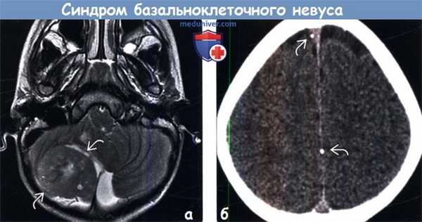 Синдром базальноклеточного невуса (СБКН) на МРТ, КТ головного мозга