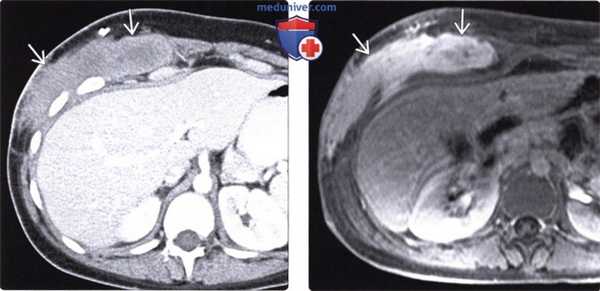 Рентген, КТ, МРТ, УЗИ при десмоидной опухоли (десмоиде)