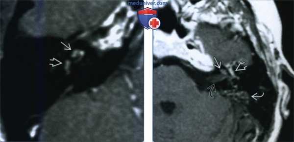 Лабиринтит - лучевая диагностика