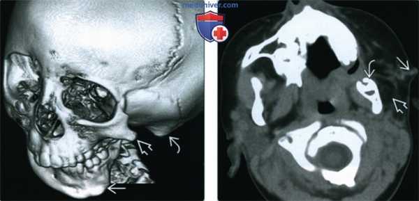 КТ, МРТ при гемифациальной микросомии