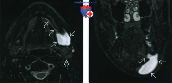 КТ, МРТ, УЗИ при рануле