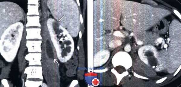 КТ при абсцессе почки