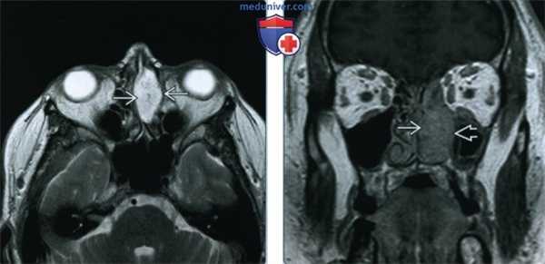 Синоназальная гемангиома - лучевая диагностика