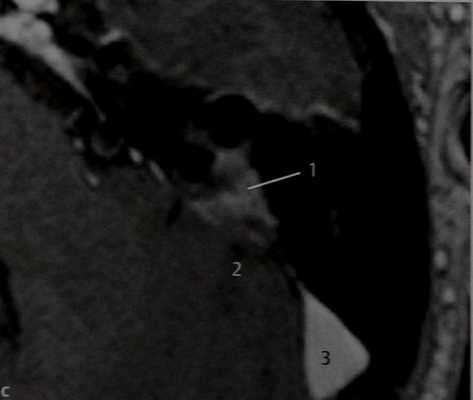 Снимки МРТ и КТ. Фиброзная дисплазия