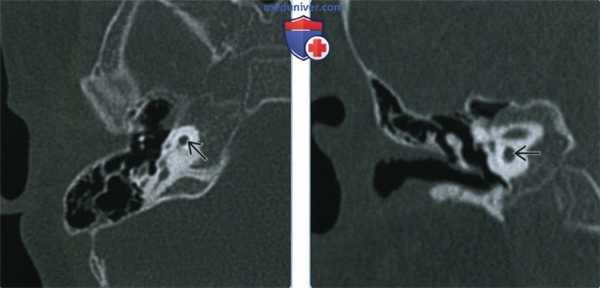 Аплазия улитки - лучевая диагностика
