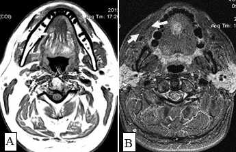 Рис. 10. А. Пациент Е., 52 года. МРТ полости рта, ротоглотки в аксиальной проекции, Т1-ВИ. Опухоль языка небольших размеров, границы визуализируются с трудом за счет перифокального отека (стрелки); В. Тот же пациент. МРТ в аксиальной проекции, Т2 с подавлением сигнала от жировой ткани. Визуализируются границы опухолевого узла, размеры опухоли языка четко определяются (стрелки)
