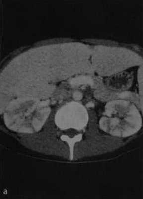 Снимки МРТ и КТ. Острый пиелонефрит