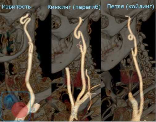 Различные виды патологической извитости сонных артерий