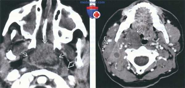 КТ, МРТ при неходжкинской лимфоме слизистой оболочки глотки