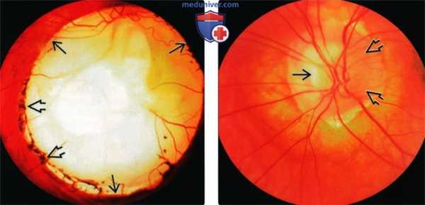 КТ, МРТ при колобоме