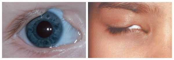 Колобома века