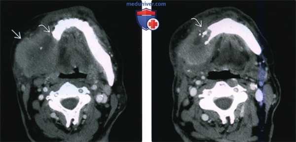 КТ, МРТ при саркоме жевательного пространства