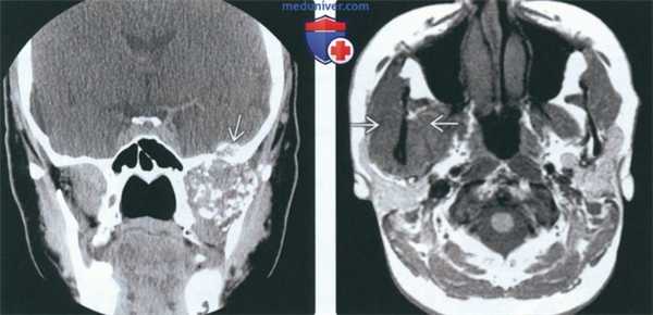 КТ, МРТ при хондросаркоме жевательного пространства