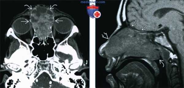 Синоназальная аденокарцинома - лучевая диагностика
