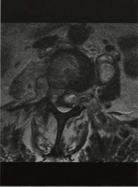 Снимки МРТ и КТ. Эпидуральный абсцесс