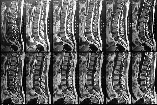 Пленка с серией снимков пояснично-крестцового отдела позвоночника в сагиттальной проекции