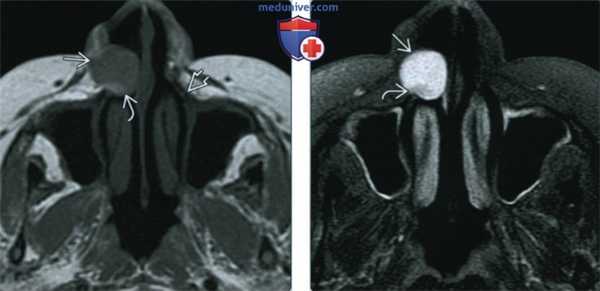Носогубная киста - лучевая диагностика