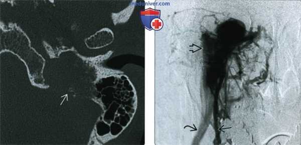 КТ, МРТ при параганглиоме яремного гломуса