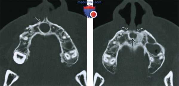 Киста носонебного протока - лучевая диагностика