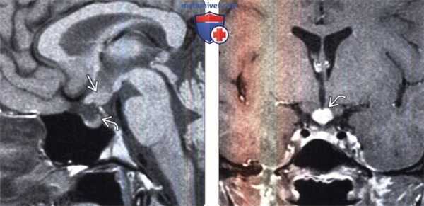 МРТ головы при гистиоцитозе из клеток Лангерганса