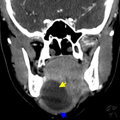 КТ слюнных желез