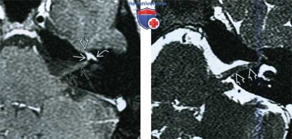 КТ, МРТ при параличе Белла