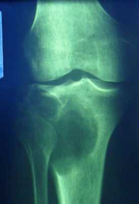 Новообразования костей12.jpg