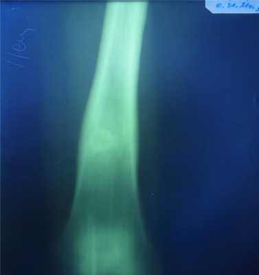 Новообразования костей3.jpg