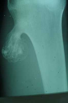 Новообразования костей4.jpg