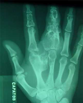 Новообразования костей6.jpg