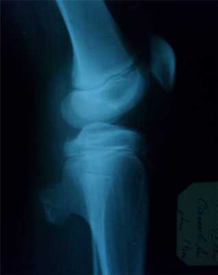 Новообразования костей1.jpg