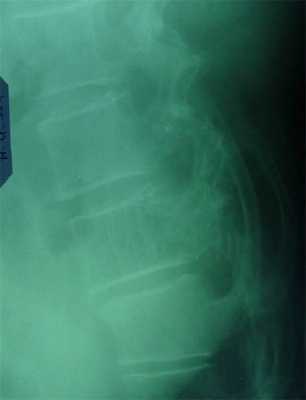 Новообразования костей11.jpg