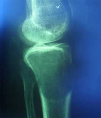 Новообразования костей9.jpg