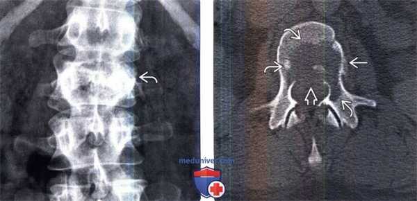 КТ, МРТ саркомы Юинга позвоночника