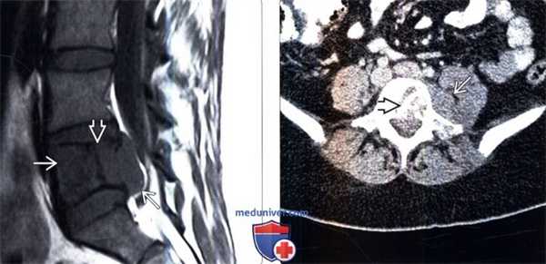 КТ, МРТ саркомы Юинга позвоночника