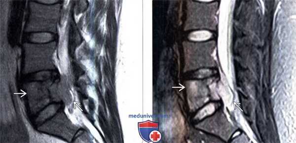 КТ, МРТ саркомы Юинга позвоночника