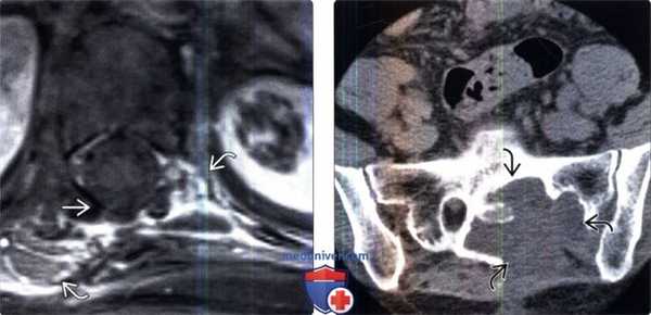 КТ, МРТ солитарной фиброзной опухоли (гемангиоперицитомы) позвоночника