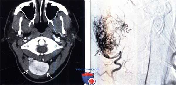 КТ, МРТ солитарной фиброзной опухоли (гемангиоперицитомы) позвоночника