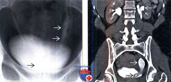 КТ, МРТ, урография при уретероцеле