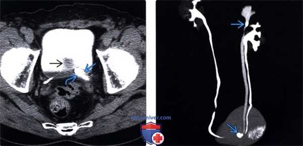 Методы обследования уретероцеле
