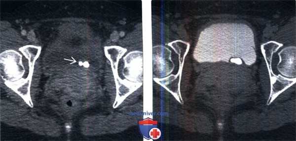 КТ, МРТ, урография при уретероцеле