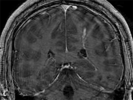венозная ангиома- МРВ
