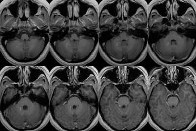 венозная ангиома мрт